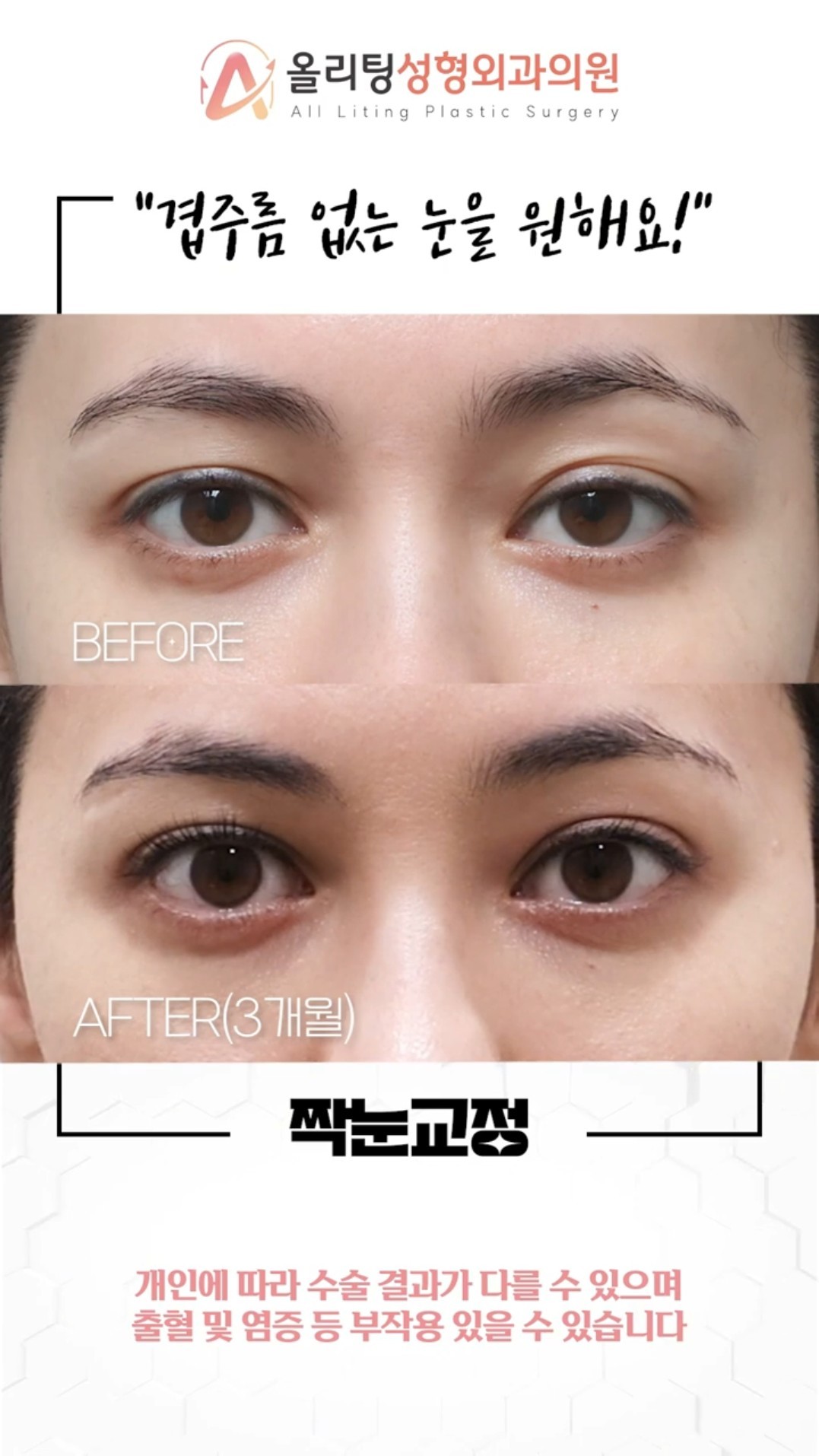 allliting Asymmetrical double eyelids