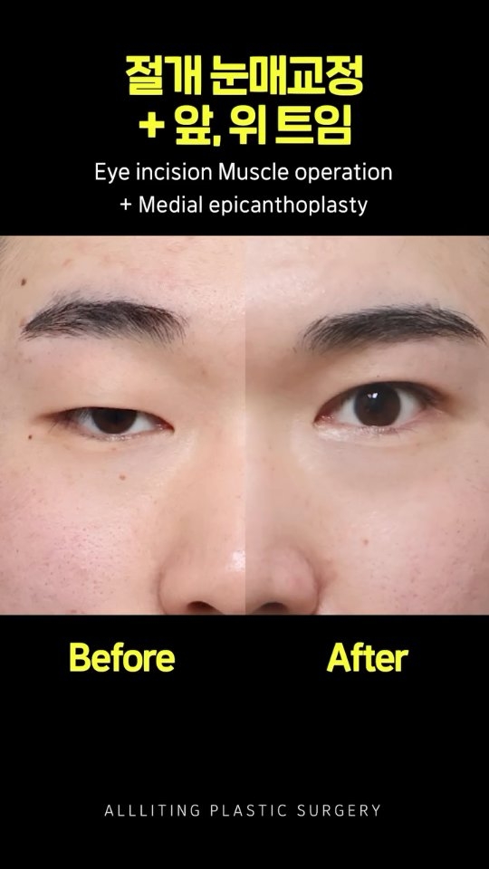 Eye incision Muscle operation + Medial epicanthoplasty