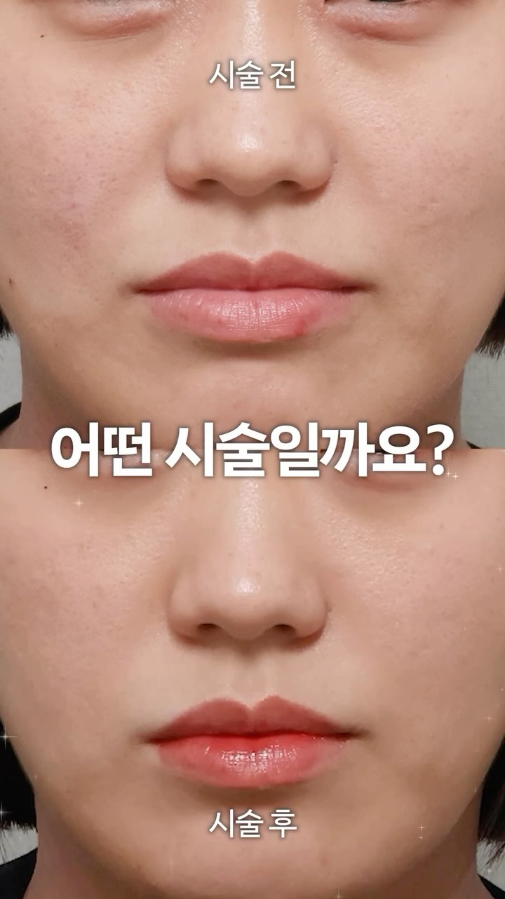 AllLiting skin booster