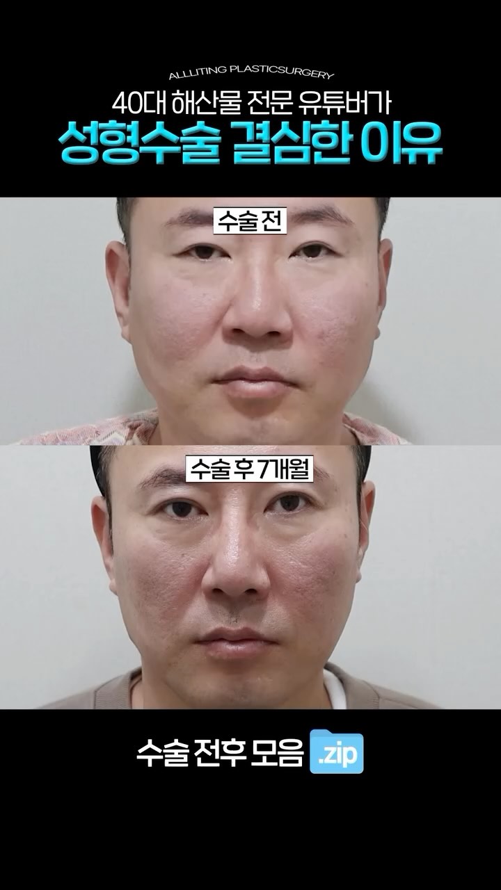 AllLiting male surgery